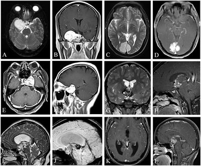 Surgical resection of intracranial cavernous hemangioma located at uncommon location: Clinical presentation and management